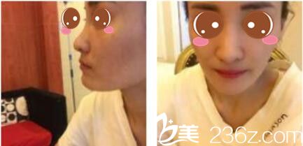 韩国李斗荣美笑整形外科李斗荣假体隆鼻真人案例术前照 韩国李斗荣美笑整形外科李斗荣假体隆鼻真人案例术前照