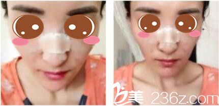 韩国李斗荣美笑整形外科李斗荣假体隆鼻真人案例术后第三天 韩国李斗荣美笑整形外科李斗荣假体隆鼻真人案例术后第三天