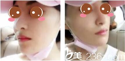 韩国李斗荣美笑整形外科李斗荣假体隆鼻真人案例术后第七天 韩国李斗荣美笑整形外科李斗荣假体隆鼻真人案例术后第七天