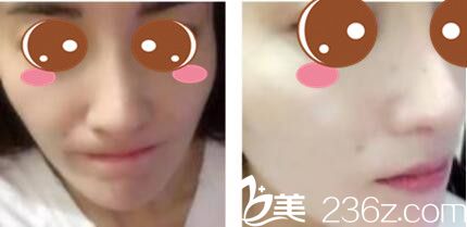 韩国李斗荣美笑整形外科李斗荣假体隆鼻真人案例术后十八天 韩国李斗荣美笑整形外科李斗荣假体隆鼻真人案例术后十八天