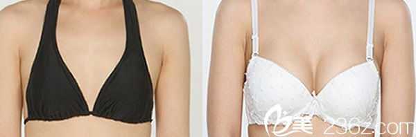 娜娜整形黄铜渊院长自体脂肪丰胸案例