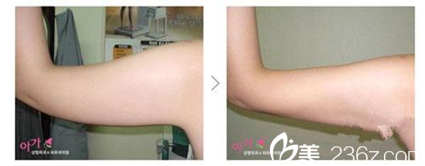 吸脂瘦手臂案例效果分享