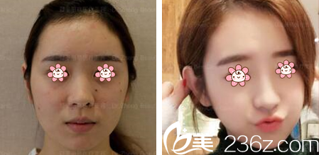 周业松院长面部线雕案例 周业松院长面部线雕案例