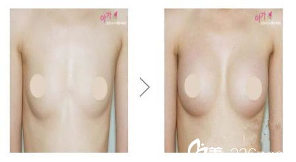 林景郁医生隆胸案例分享 林景郁医生隆胸案例分享