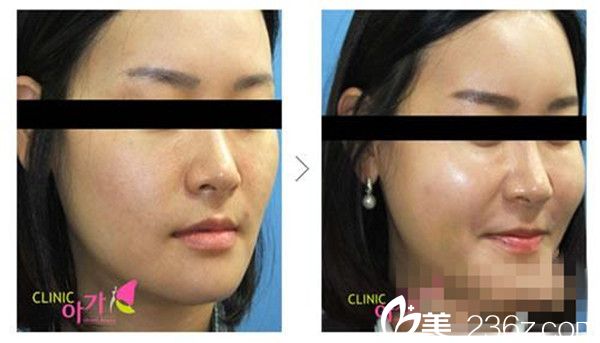 自体脂肪丰额头案例分享 自体脂肪丰额头案例分享