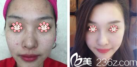 代晓蓉主任皮肤祛痘祛斑美容案例 代晓蓉主任皮肤祛痘祛斑美容案例