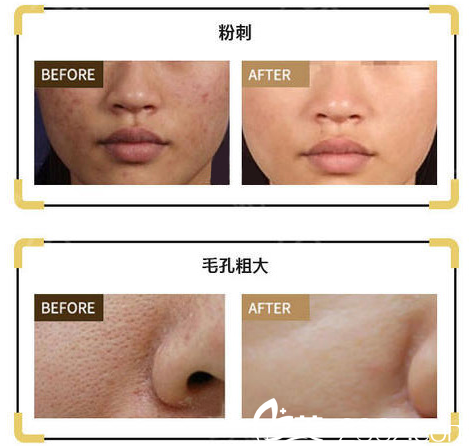 金蓓蕾医生擅长推荐DPL<span style=