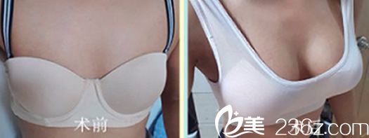 韩国娜娜整形外科隆胸前后效果对比案例