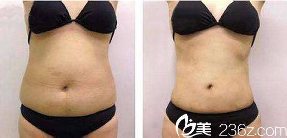娜娜整形外科医院腰部抽脂案例