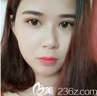 术后30天，我已经完全恢复了