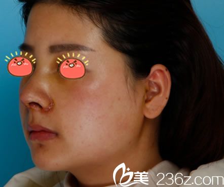 做完隆鼻手术7天拆线<span style=