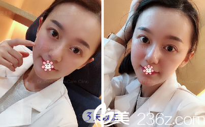 周业松面部线雕提升加玻尿酸填充苹果肌术后第三天 周业松面部线雕提升加玻尿酸填充苹果肌术后第三天