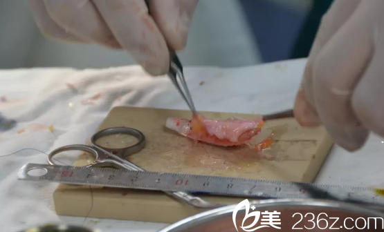 筋膜覆盖假体,增加鼻背的厚度 筋膜覆盖假体,增加鼻背的厚度