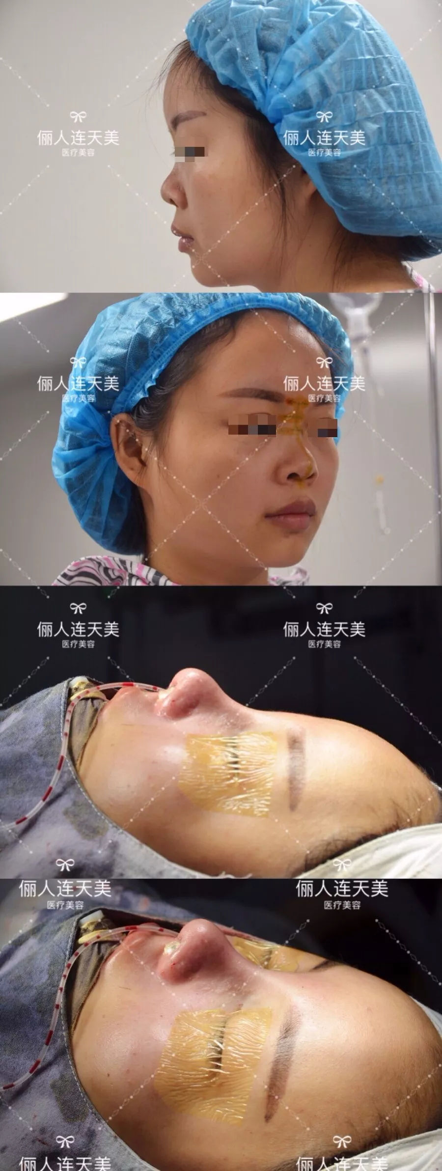 在南通俪人连天美做隆鼻失败修复<span style= 在南通俪人连天美做隆鼻失败修复<span style=