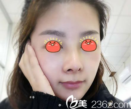 宁波薇琳医美做隆鼻20天恢复图