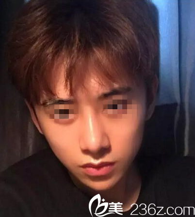 分享我找桂林时光美莱毛建文做鼻综合手术1个月就恢复的超级自然