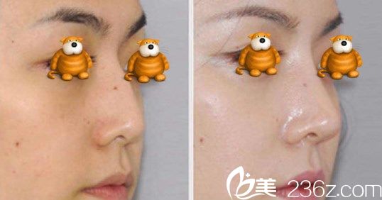 金亨俊院长肋骨隆鼻改善鼻中隔弯曲案例