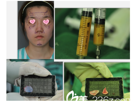 北京米扬丽格做隆鼻脂肪填充当天样子