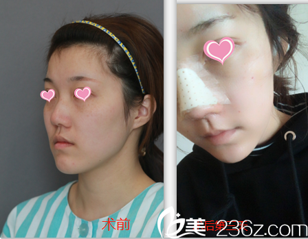 北京米扬丽格巫文云鼻综合面部脂肪填充案例
