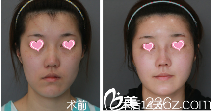 巫文云鼻综合面部脂肪填充案例术前与第14天效果