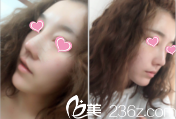 北京米扬丽格鼻综合面部脂肪填充案例