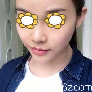 鼻综合整形术前照 鼻综合整形术前照