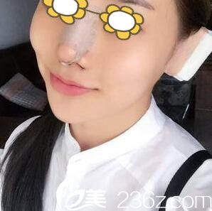 鼻综合术后第三天 鼻综合术后第三天