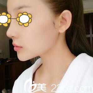 鼻综合术后一周拆线 鼻综合术后一周拆线