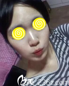 鼻整形术前照 鼻整形术前照