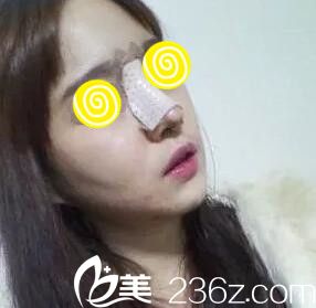 鼻整形术后第3天 鼻整形术后第3天