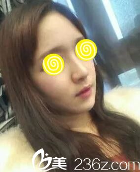 鼻整形半个月 鼻整形半个月