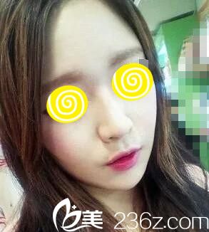 鼻整形术后1个月<span style= 鼻整形术后1个月<span style=