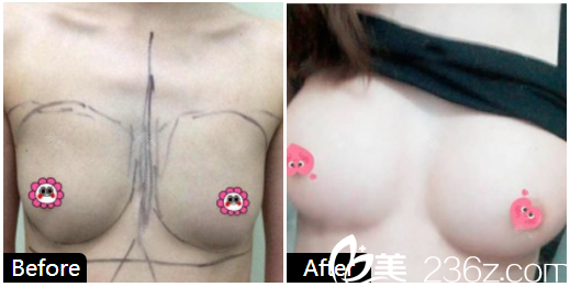 深圳臻希美医疗美容贾维顺自体脂肪隆胸案例