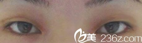 娜娜整形医院手术前图片 娜娜整形医院手术前图片