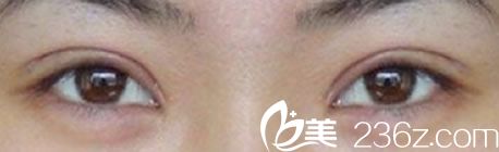 崔相錄医生全切双眼皮恢复后案例 崔相錄医生全切双眼皮恢复后案例