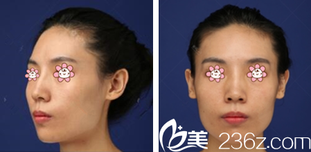 术前的我 术前的我