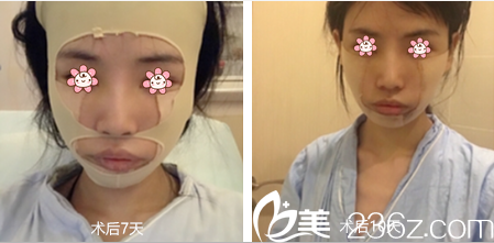 在韩国JSTAR整形外科做完手术差不多快半个月了 在韩国JSTAR整形外科做完手术差不多快半个月了