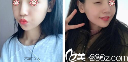 韩国JSTAR整形外科颧弓内推和下颌角整形术后半个多月 韩国JSTAR整形外科颧弓内推和下颌角整形术后半个多月