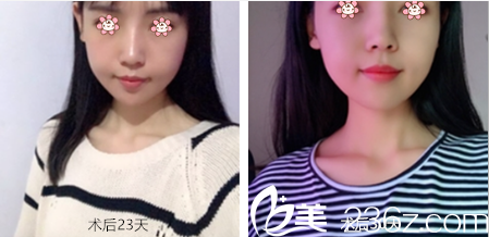 离去年去韩国JSTAR整形外科郑宰学那儿做颧弓内推和下颌角整形也快一年了。