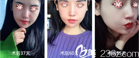 术后快三个月了 术后快三个月了