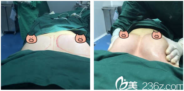 深圳<!--<i data=20240703-sp></i>-->贾维顺自体脂肪丰胸术前术后对比 深圳<!--<i data=20240703-sp></i>-->贾维顺自体脂肪丰胸术前术后对比