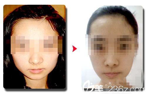 韩国伍人整形医院下颌角手术案例分享 韩国伍人整形医院下颌角手术案例分享