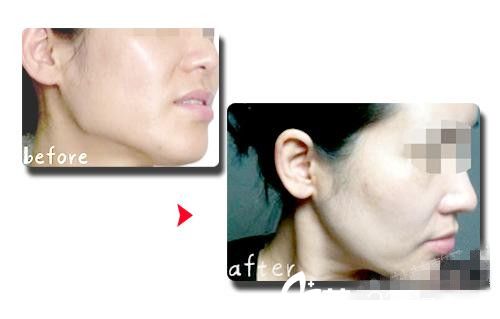 韩国伍人整形医院下颌角手术案例分享 韩国伍人整形医院下颌角手术案例分享