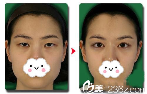 魏成润院长下颌角手术案例 魏成润院长下颌角手术案例