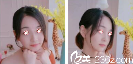 林钟学玻尿酸填充下巴加太阳穴术后半个月 林钟学玻尿酸填充下巴加太阳穴术后半个月