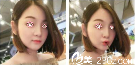 我趁在韩留学工夫去了韩国KAIROS整形林钟学那儿做了玻尿酸填充太阳穴垫下巴。