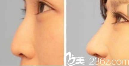 韩国青春整形外科隆鼻效果对比照