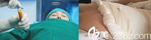 自体脂肪隆胸手术第2天