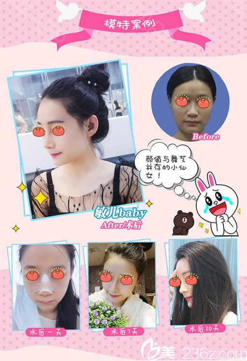 金华玥莱美高顺福隆鼻案例