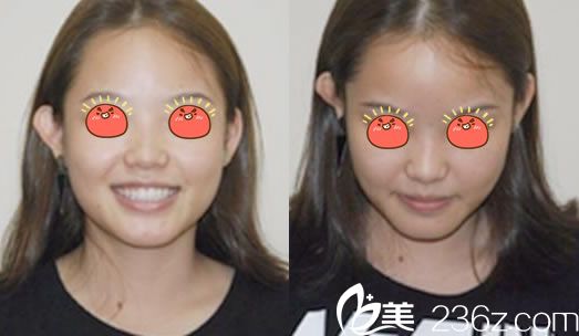 注射玻尿酸隆鼻被吸收的效果 注射玻尿酸隆鼻被吸收的效果